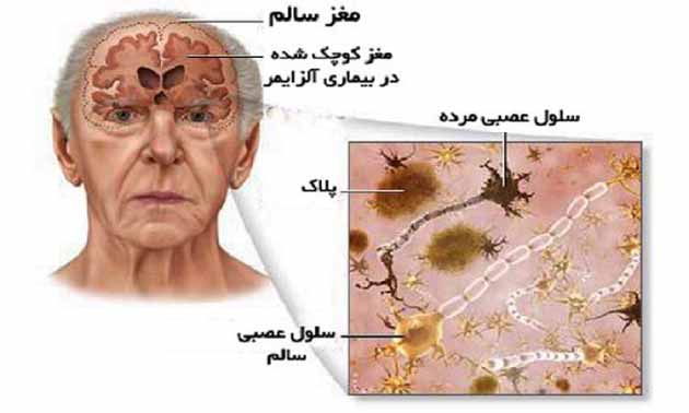 درمان بیماری آلزایمر