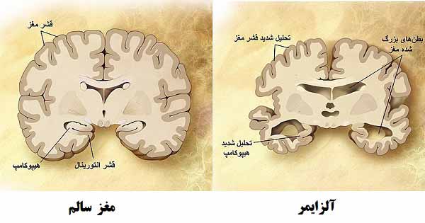 علائم بیماری آلزایمر و درمان بیماری