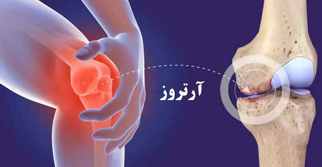 بیماری آرتروز