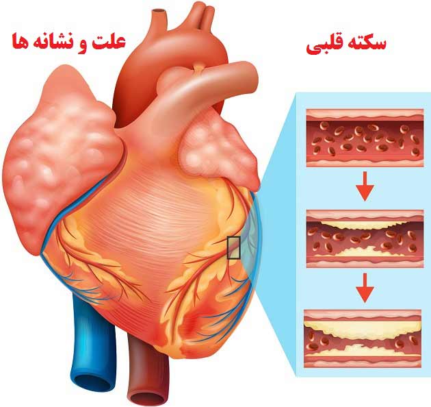 علت، علائم و نشانه های بیماری سکته قلبی