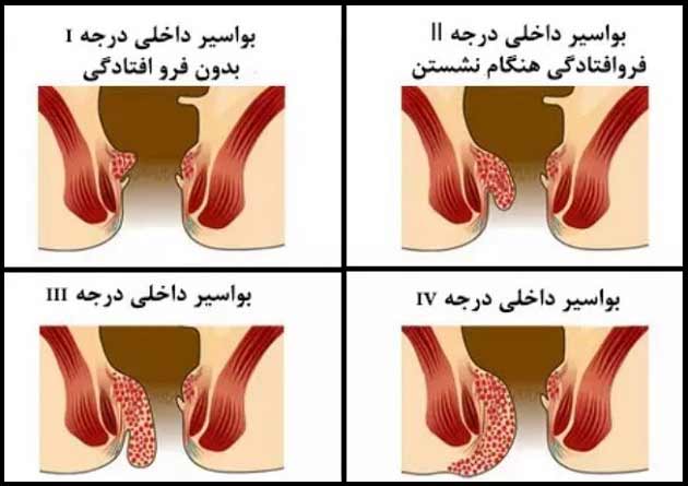 علاوم و نشانه های بیماری هموروئید (بواسیر)