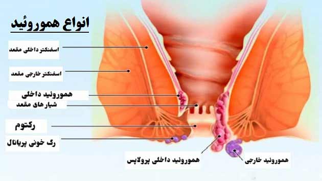 علت بیماری هموروئید (بواسیر) + علائم، درمان و سبک زندگی