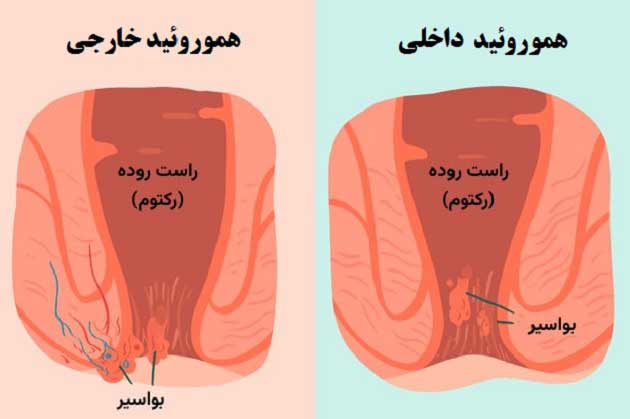 گوشت اضافه مقعدی بعد از زایمان