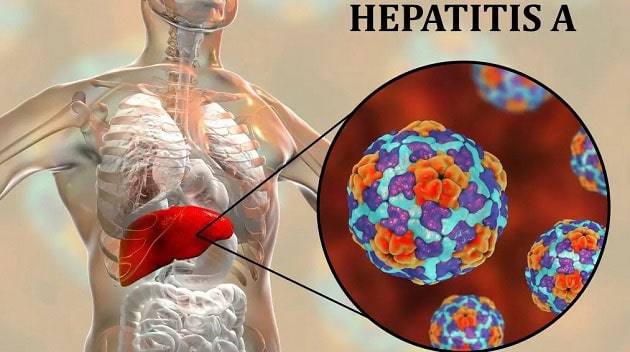 علت، علائم و نشانه های بیماری هپاتیت