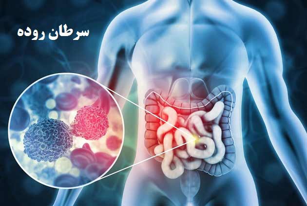 روشه ای تشخیص و روش های درمانی سرطان روده
