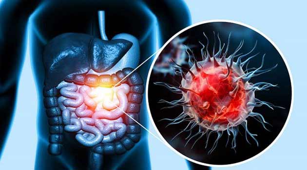 علت، علائم و نشانه های بیماری سرطان روده