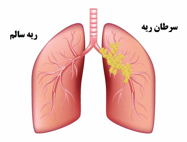 علائم سرطان ریه علائم سرطان ریه