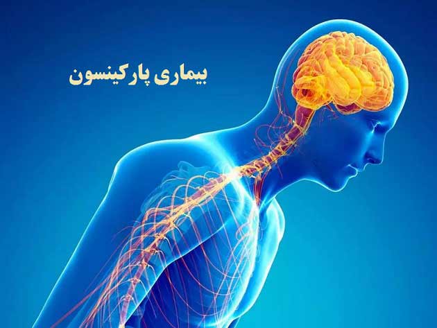 بیماری پارکینسون