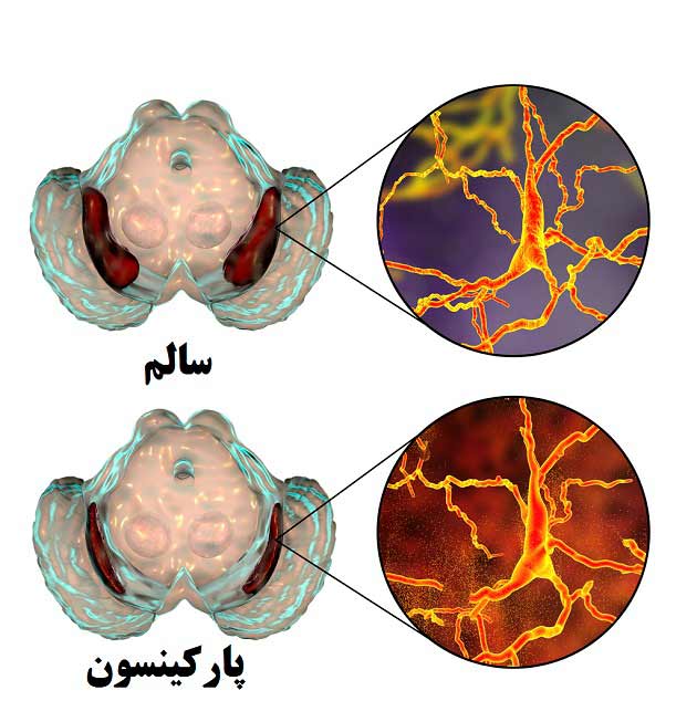 علت بیماری پارکینسون + علائم، روش درمان و سبک زندگی مناسب