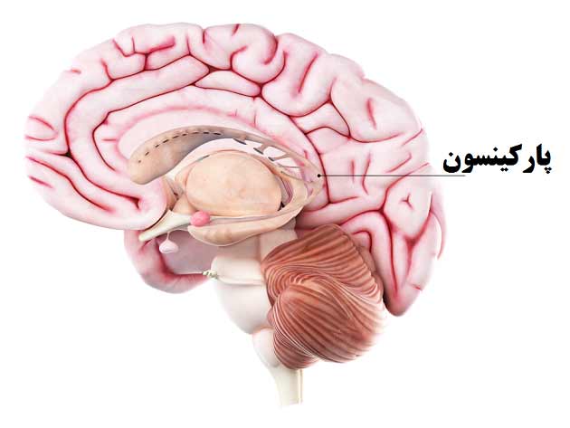 روش های درمانی بیماری پارکینسون