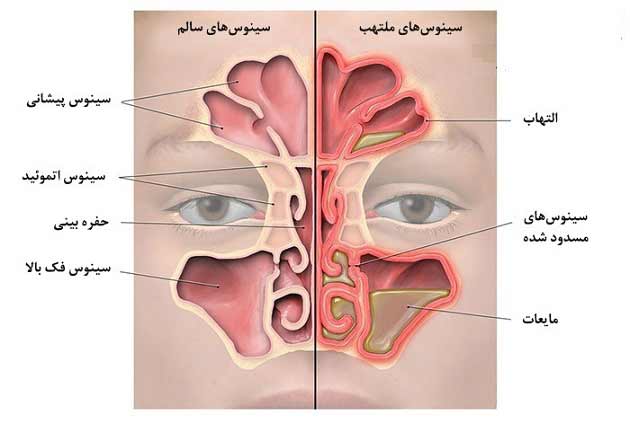 علت، علائم و نشانه های بیماری سینوزیت