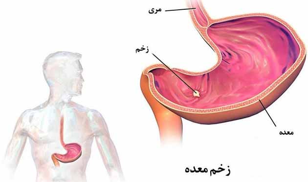 علاوم و نشانه های بیماری زخم معده