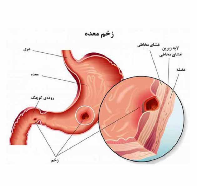 بیماری زخم معده