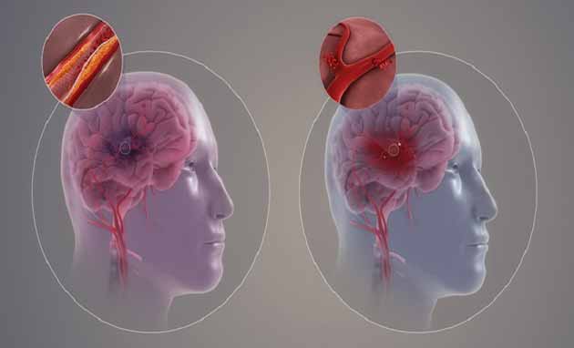 علائم بیماری سکته مغزی + روش های درمانی