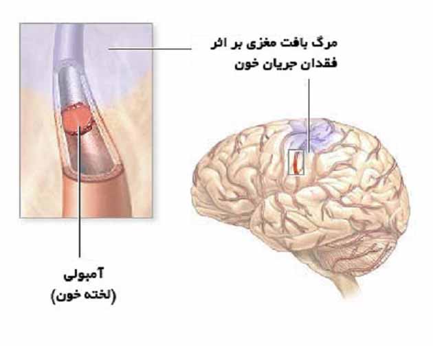علت بیماری سکته مغزی + علائم، روش های درمانی و سبک زندگی مناسب