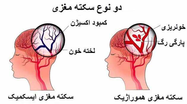 انواع بیماری سکته مغزی و علت آن