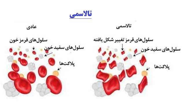 علت و علائم بیماری تالاسمی