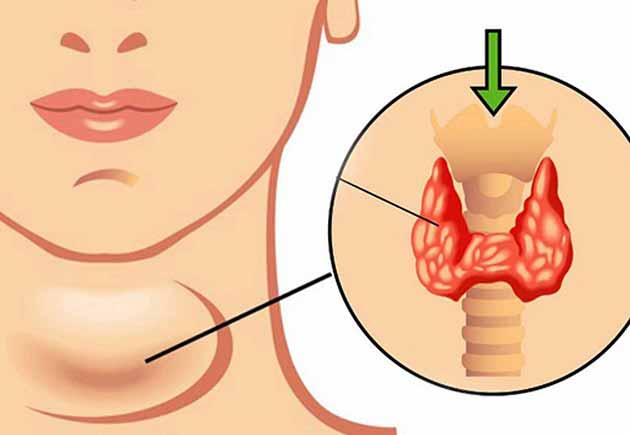 روش های تشخیص و درمان بیماری تیروئید