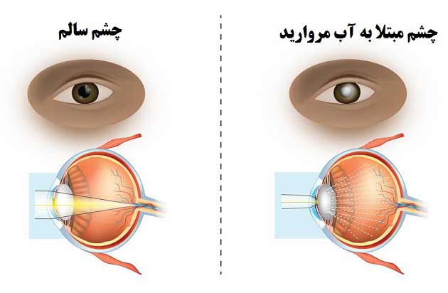 روش دارویی برای درمان بیماری چشمی آب مروارید یا کاتاراکت
