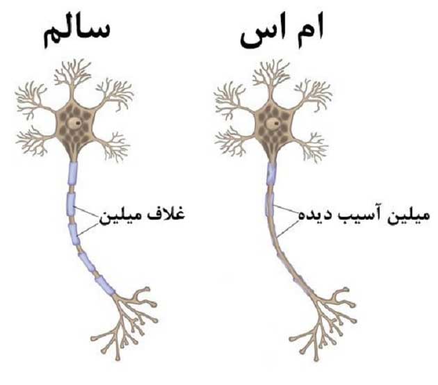علت، علائم و نشانه های بیماری ام اس