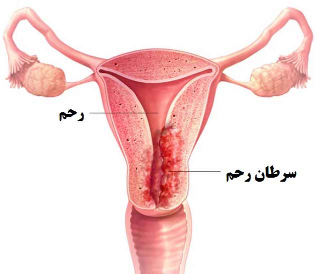 علت بیماری سرطان رحم + نشانه ها، روش درمان و سبک زندگی مناسب